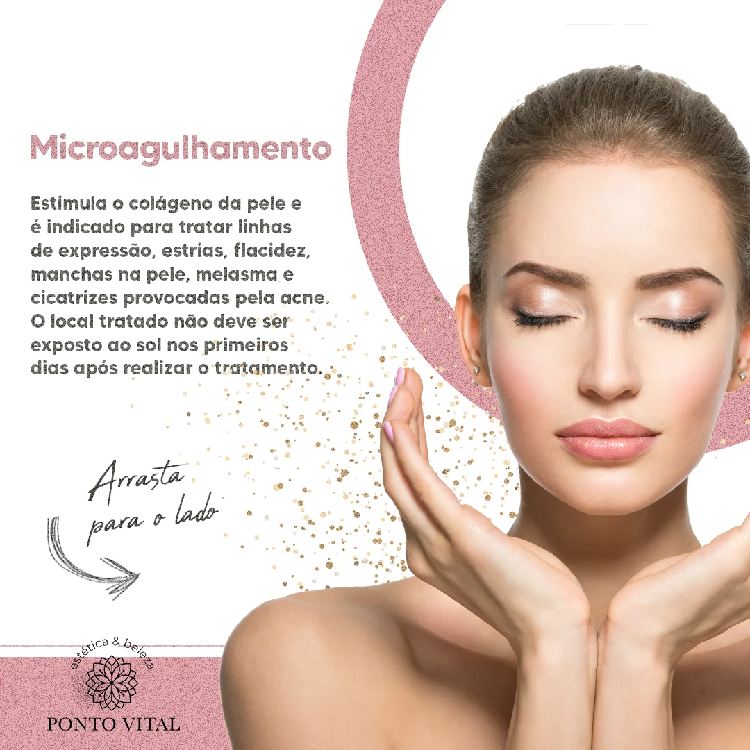 04 - Microagulhamento - Clínica Estética Ponto Vital - Clínica Ponto Vital - Estética avançada - Estética Campo Largo